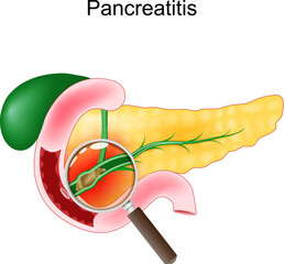 Acute pancreatitis. Close-up of a realistic pancreas, duodenum, and gallbladder