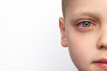 Closeup of a child's face with a red eye, isolated on a white background with copy space. Swelling...
