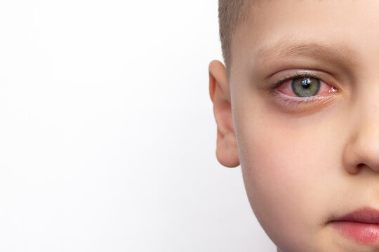 Closeup of a child's face with a red eye, isolated on a white background with copy space. Swelling of the eyelids, irritation and itching of the eyes caused by conjunctivitis, inflammation, infection