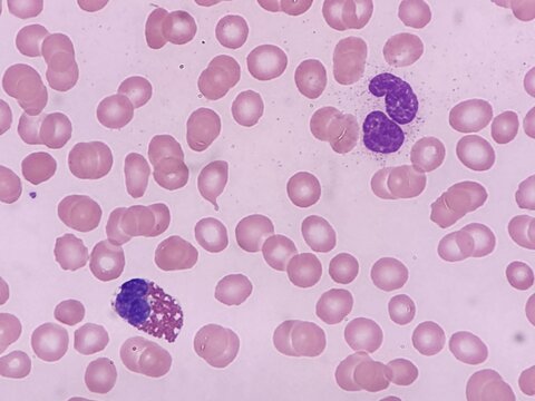Eosinophil and neutrophil seen on peripheral blood smear