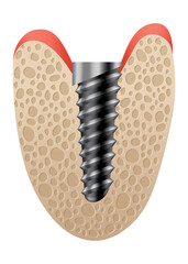 Dental implant structure. Medical educative infographic poster. Teeth implant, realistic  design of dentistry. Implant screw, healthcare, dentist and orthodontist treatment