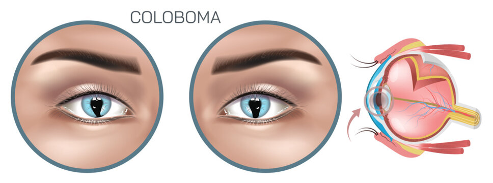 Coloboma is a congenital condition characterized by a gap or notch in one of the eyes structures, typically affecting the iris, retina, choroid, or optic disc. eye diseases and syndromes vector