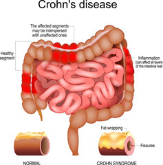 Crohn disease. intestine with Inflammation - obrazy, fototapety, plakaty