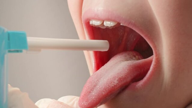 Sore throat is sprayed with a therapeutic spray. Tonsillitis. 