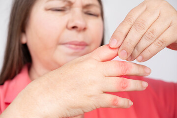 Elderly woman suffering from arm pain, massage finger with painful swollen gout inflammation,...