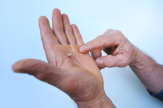 close-up skin with wound on painful male hand, bursting calluses on palm, rubbing of skin with rough tool, sports equipment, callus removal, hand protection, rehabilitation, pain relief