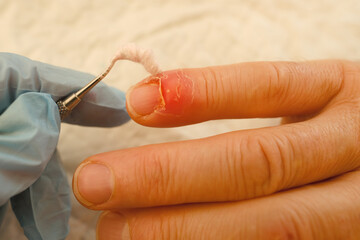 Medical Treatment for Finger Injuries, doctor treats injured finger, nail damage from impact,...