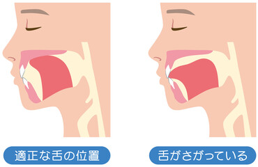 正しい舌の位置と下がっている舌の位置