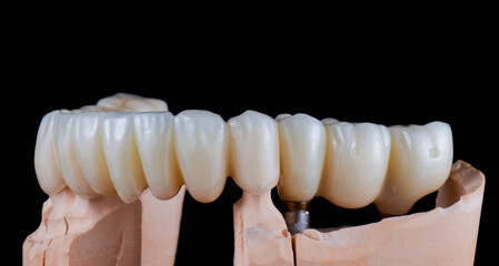 emax ceramic cowens on implants 