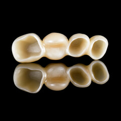 emax ceramic cowens on implants 