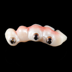 emax ceramic cowens on implants 