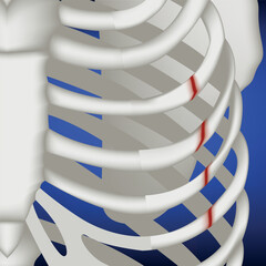 Broken ribs on a blue background, close-up. Medical poster, vector isolated illustration - obrazy, fototapety, plakaty