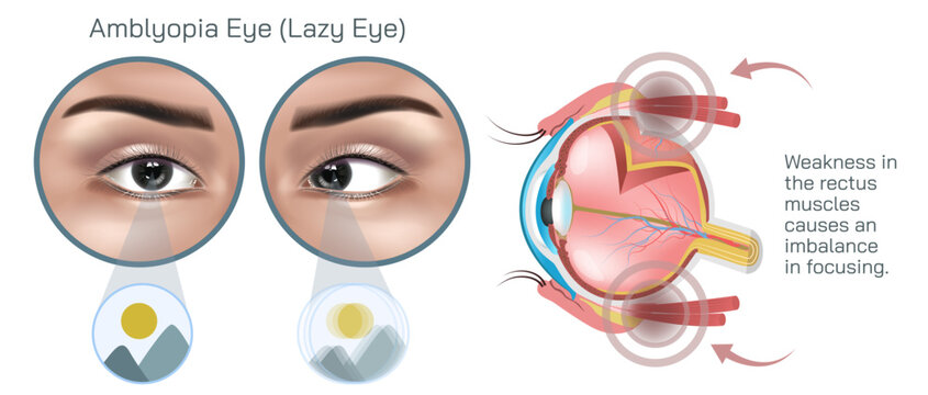 Amblyopia, often referred to as lazy eye is a condition characterized by reduced vision in one or both eyes that is not due to any structural abnormalities of the eye vector illustration.