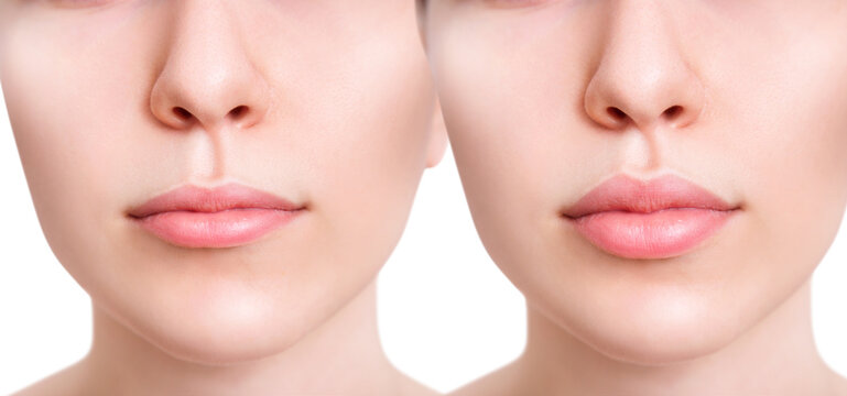 Female lips before and after augmentation procedure.