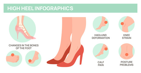 High heels harm for female feet. Foot disease medical poster. Deformity of bones and joints. Orthopedic problem. Uncomfortable woman footgear. Anatomy infographic. Garish vector concept - obrazy, fototapety, plakaty