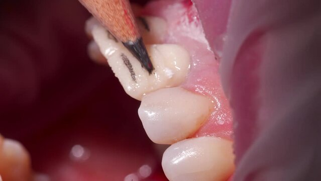 Dental zirconia veneer preparation. Close-up macro shot of marking depth cutting for ceramic space thickness by the pencil. Dentist preparing teeth for installation of porcelain veneers and crowns.
