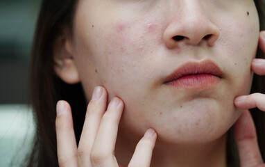 Acne pimple and scar on skin face, disorders of sebaceous glands, teenage girl skincare beauty problem.