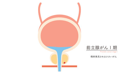 前立腺の医療イラスト、前立腺癌のステージ1