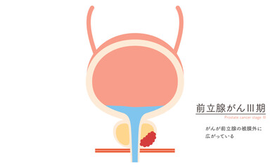 前立腺の医療イラスト、前立腺癌のステージ3