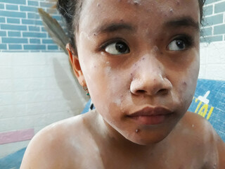 Selective focus portrait of elementary age girl using powder for itching due to chickenpox....