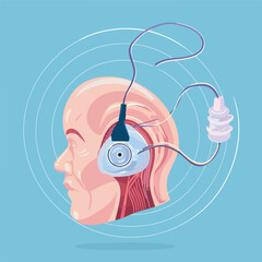 Cochlear implant device electrically stimulates ner