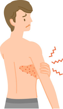 帯状疱疹：背中から胸にかけて痛みやかゆみ、腫れがある男性（後ろ姿）