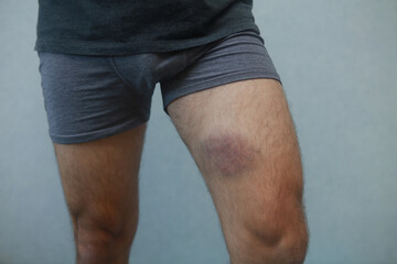 large hemotoma on a man's leg on a gray background