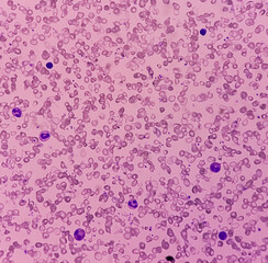 Blood smear, Hereditary hemolytic anemia. Hemoglobin E (HbE) disease. pencil cell, target cell,...