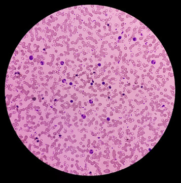 Blood smear, Hereditary hemolytic anemia. Hemoglobin E (HbE) disease. pencil cell, target cell, tear drop cell. occasional nRBC incresed. Thalassemia disease.