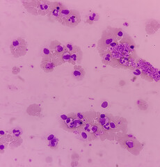 Blood smear, Hereditary hemolytic anemia. Hemoglobin E (HbE) disease. pencil cell, target cell,...