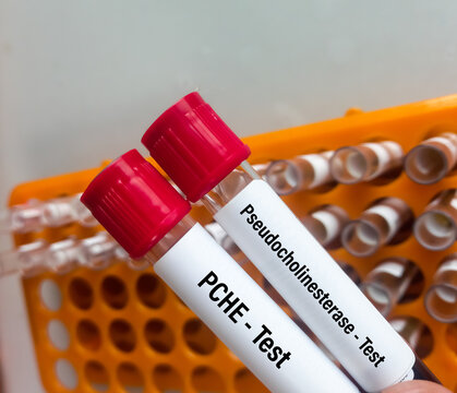 Blood sample for pseudocholinesterase (PCHE) test to diagnose inherited pseudocholinesterase deficiency. Cholinesterase Test