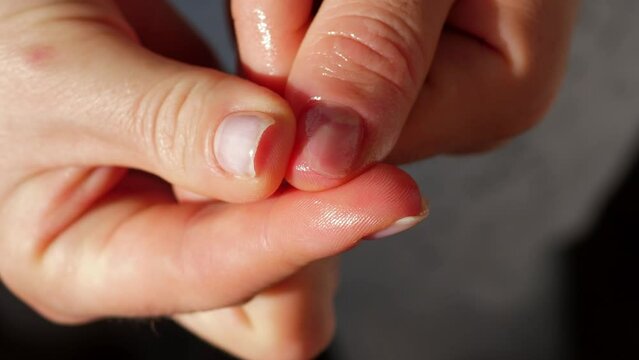 Close-up of a woman applying healing oil to a damaged detached nail, onycholysis. Monarda oil. Treatment with a podologist. Onycholysis is the detachment of the nail from the nail bed.