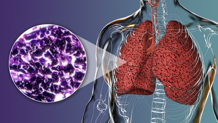 Smoker's lungs, 3D illustration along with a photomicrograph