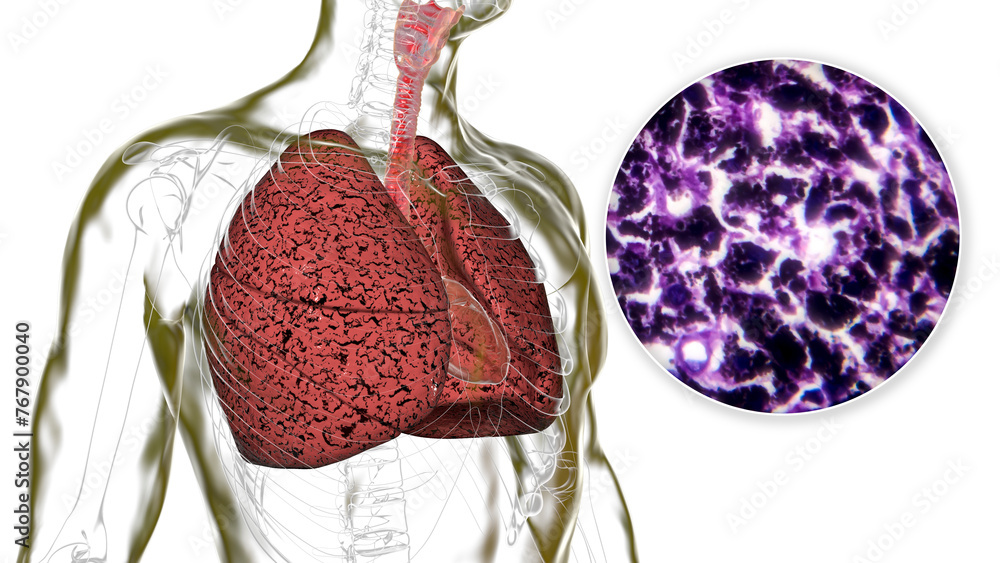 Sticker Smoker's lungs, 3D illustration along with a photomicrograph