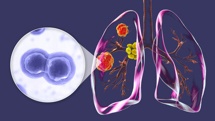 Pulmonary blastomycosis with lung lesions and enlarged bronchial lymph nodes, 3D illustration