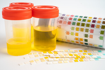 Urinalysis, urine cup with reagent strip pH paper test and comparison chart in laboratory.