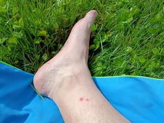 pie sobre la hierba con rastros de picaduras de mosquitos