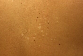 Fungal Affliction: White Spots Caused by Skin Fungus. Tinea versicolor