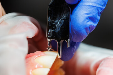 Close-up dental treatment, dental treatment of teeth.