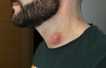 lipoma en el cuello infecctado y rojo de un hombre con barba