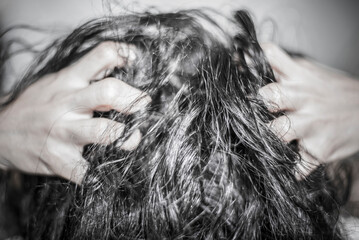 Fototapeta premium Dandruff and fungus on the scalp cause itching.