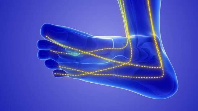 A neuroma also known as Morton's neuroma