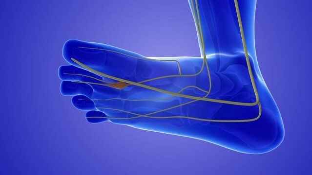 Neuroma painful foot condition or pinched nerve	