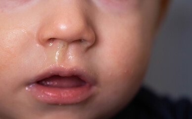 Fototapeta premium Close-up of a small child's face and nose with snot. The concept of colds, rhinitis and runny nose in children.
