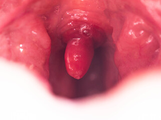 Uvulitis and sore throat in the oral cavity due to illness. Inflammation of the uvula and tonsils...