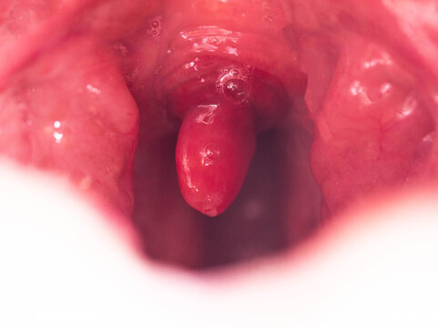 Uvulitis and sore throat in the oral cavity due to illness. Inflammation of the uvula and tonsils due to infections during illness, close-up, streptococcus. Allergy