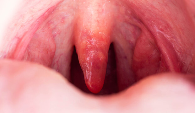 Inflammation of the uvula in the oral cavity due to infection and virus. Treatment of the disease is uvulitis. Red throat due to illness, close-up