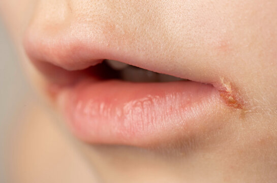 Seizures on the corners of the lips of a child s mouth. Bacterial disease of inflammation of the corners of the lips. Angular stomatitis with reduced immunity in a child, macro