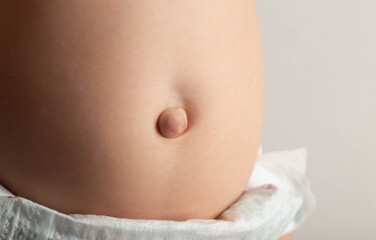 Umbilical hernia in newborns on the stomach, close-up. Treatment of hernias in children without...