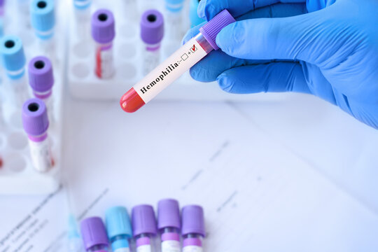Doctor holding a test blood sample tube with positive Hemophilia test on the background of medical test tubes with analyzes.